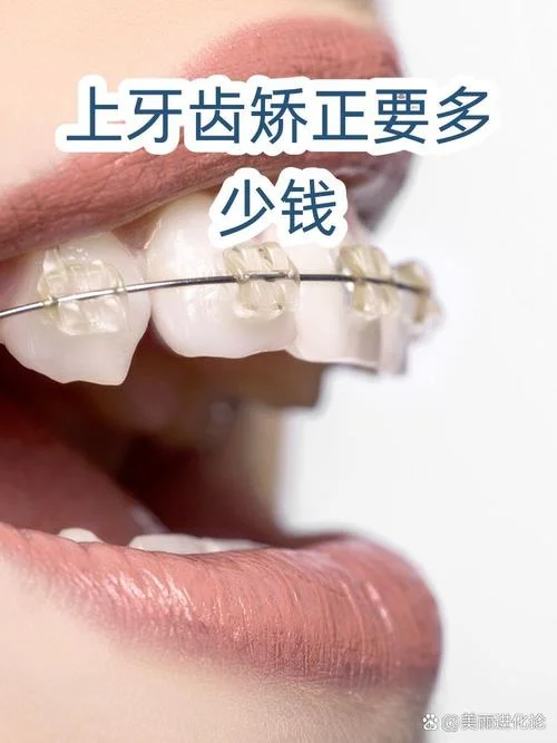 上排牙齿矫正多少钱_2