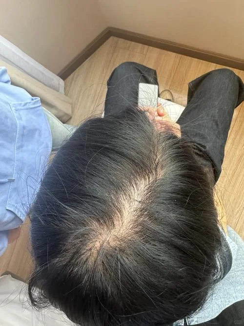 做梦梦到头发秃了_1