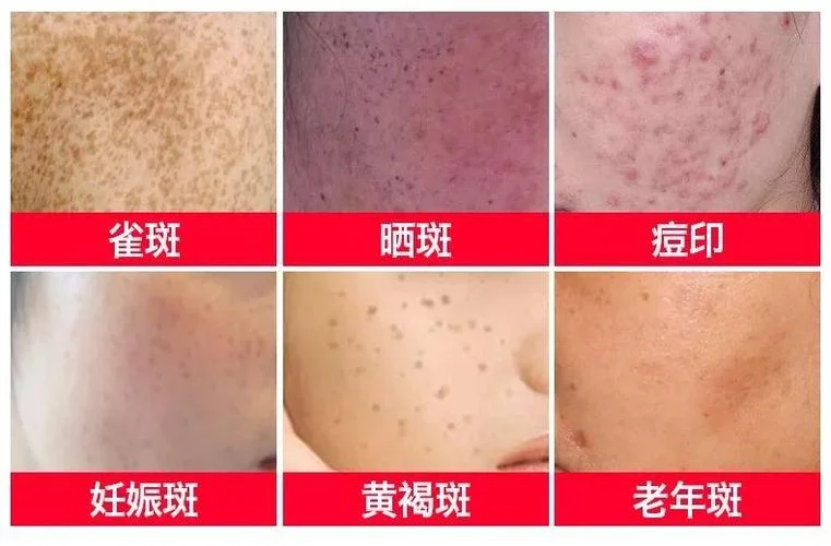脸部有红色斑癣怎么办-面部红斑斑癣怎么办