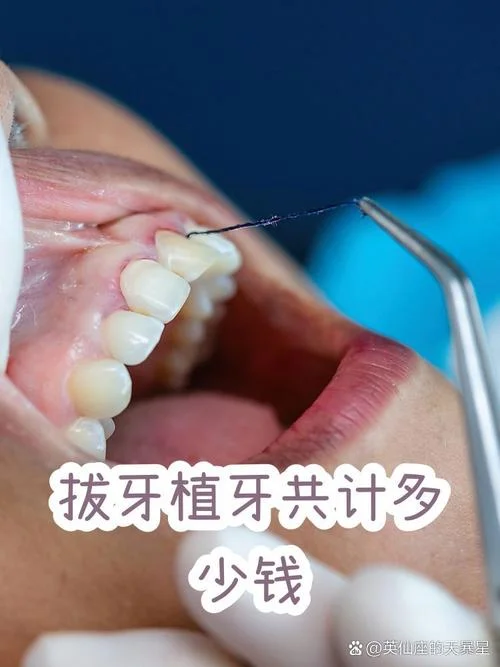 拔牙种牙需要多少钱呢-拔牙种牙费用多少