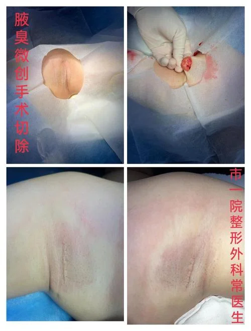 狐臭动手术是割什么的_1