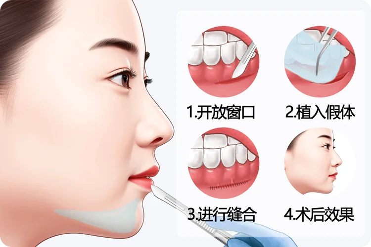 梦见假体下巴歪了_1