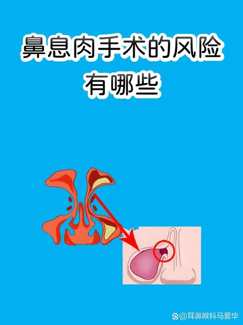 广州鼻息肉手术多少钱_1
