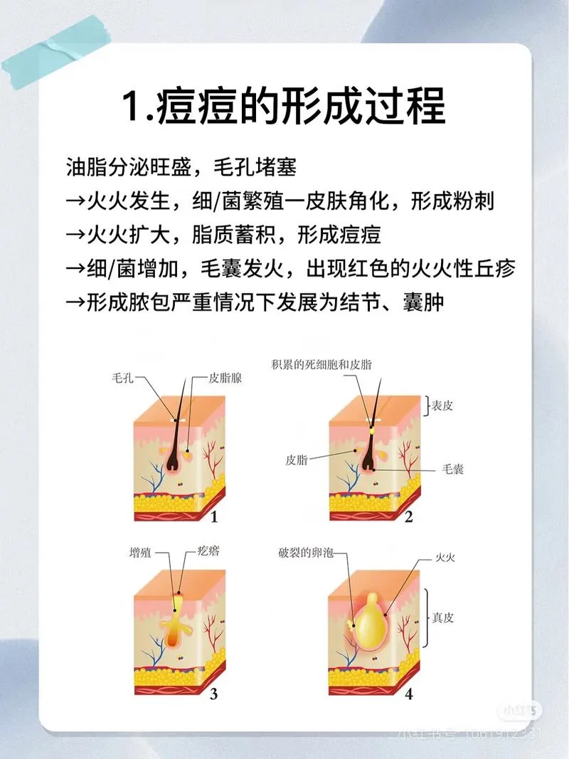 脉冲激光祛痘原理-脉冲激光祛痘原理