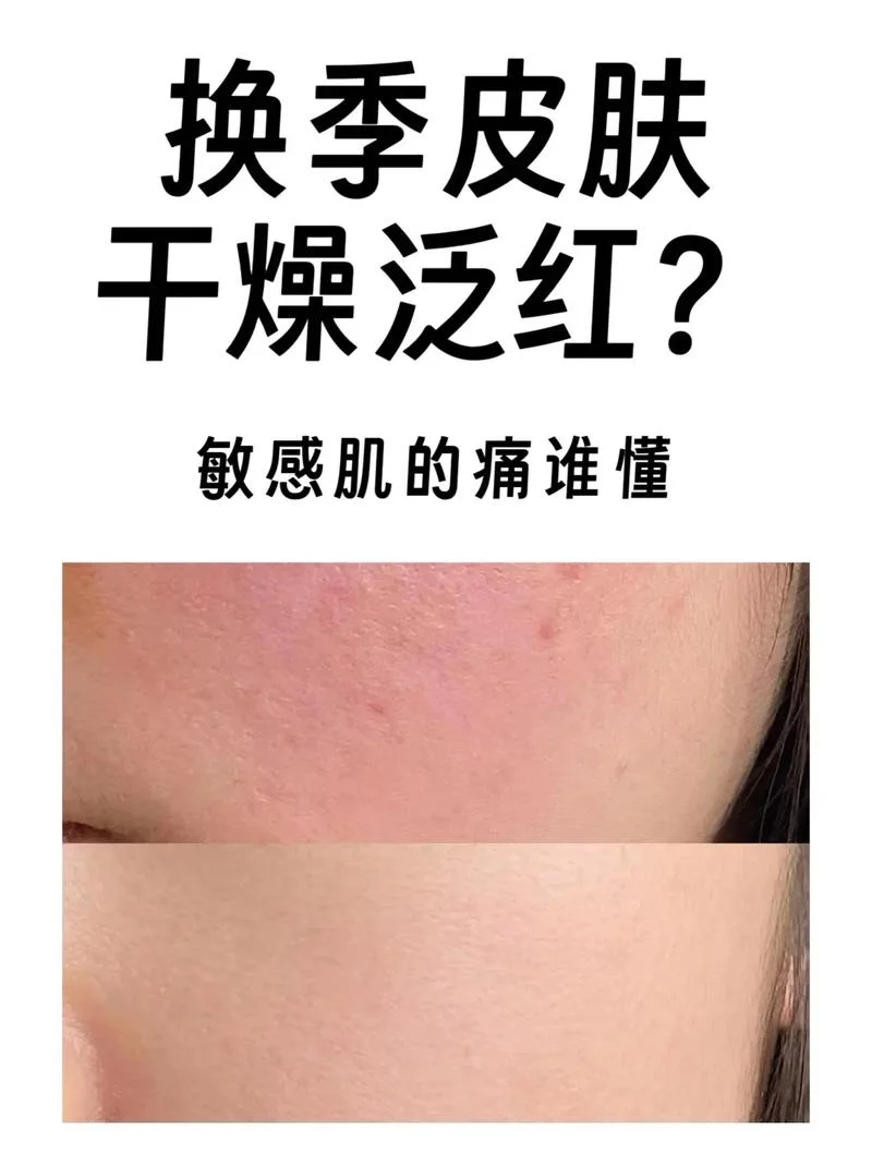 脸上容易泛红怎么办-脸上泛红怎么办