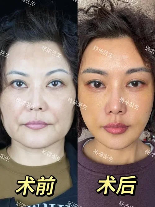大v脸提升多少钱_1