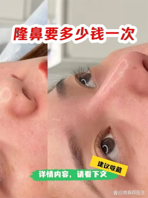 做硅胶隆鼻需要多少钱_2