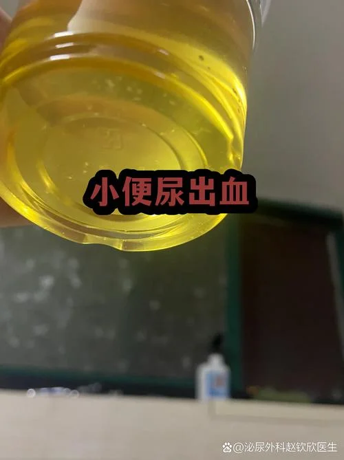 梦见血尿是什么兆头_1