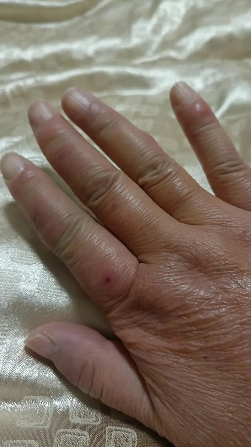 梦见别人手冻疮-梦见他人手冻疮