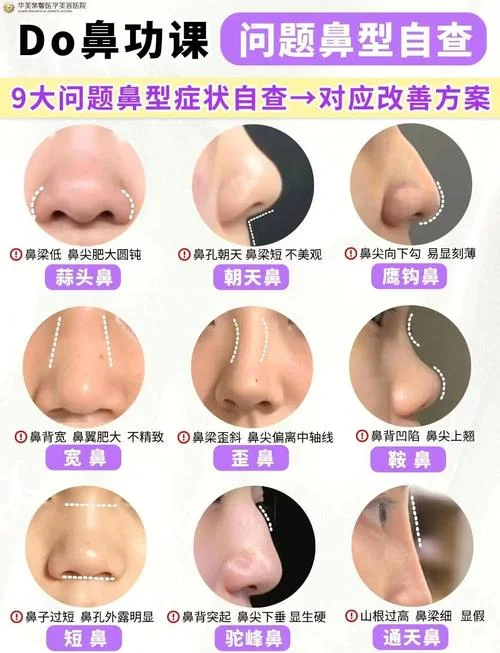 蒜头鼻整容要多少钱_1