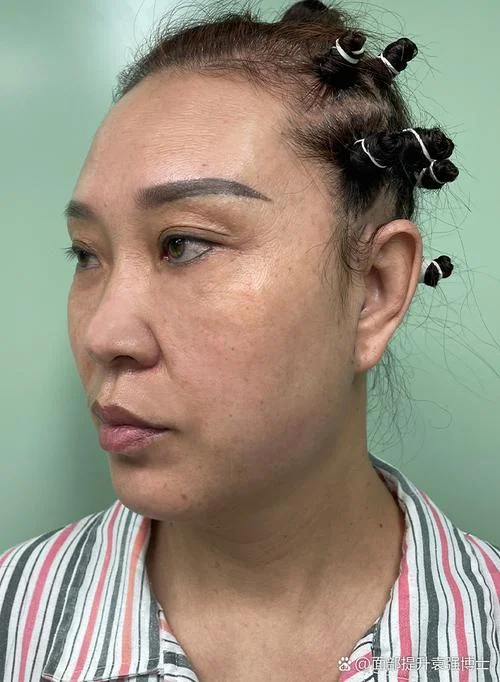 什么是拉皮手术后遗症_1