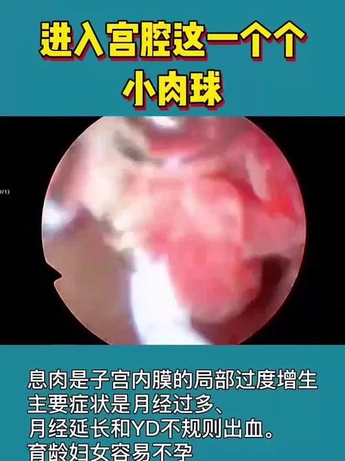 什么是子宫息肉样增生-什么是子宫息肉样增生
