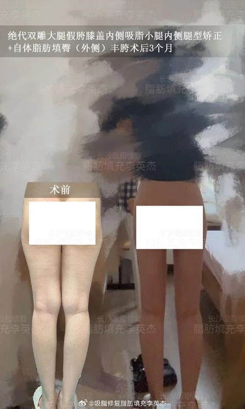 整条腿抽脂瘦腿话要多少钱_1