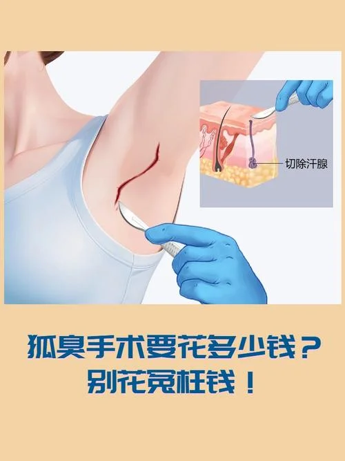 腋臭微创术一共多少钱_2