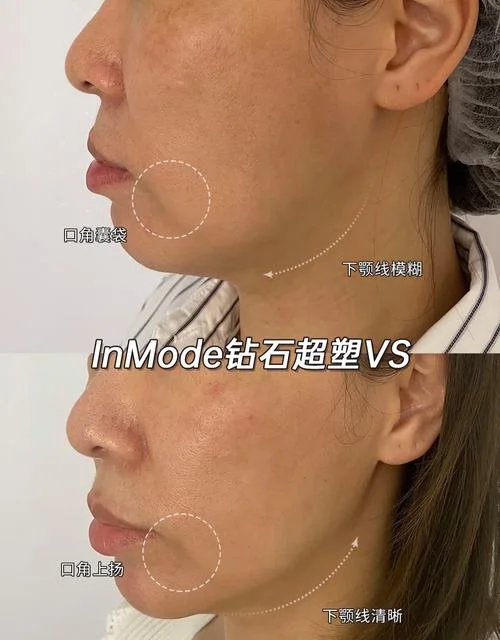 超声波美塑_1
