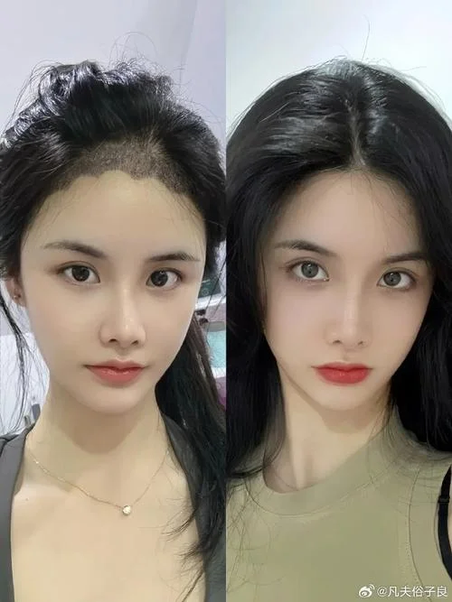 发际线整形要多少钱_1