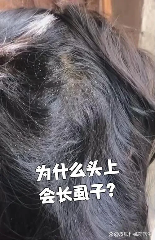 梦见自己头上好多虱子_2