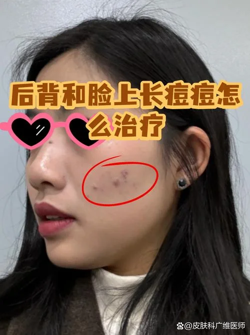孕期脸上胸前背上长痘痘怎么办_2