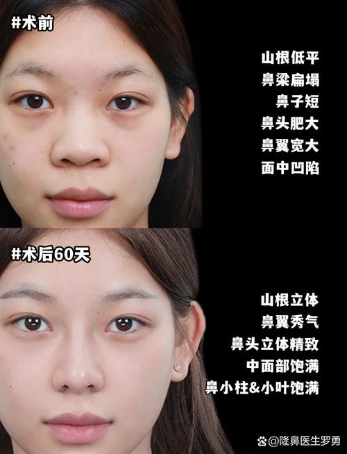 达拉斯鼻综合包括什么项目_2