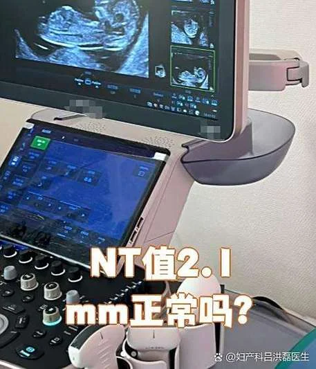 怀孕nt检查是查什么-NT 检查查胎儿结构