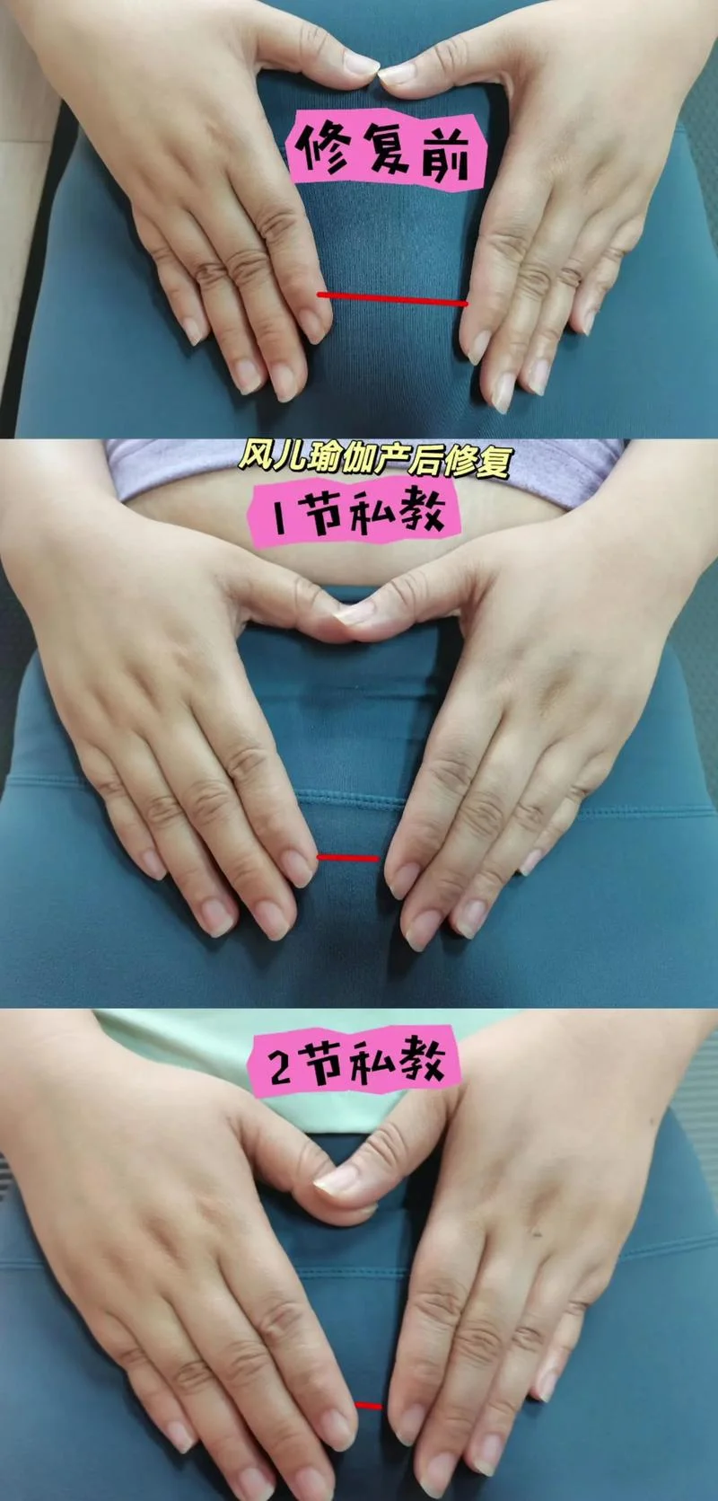骨盆修复是怎么做_2