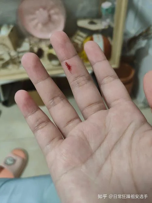 梦见被人咬出血_2