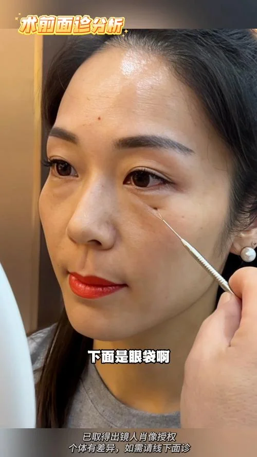祛眼袋手术怎么做_1