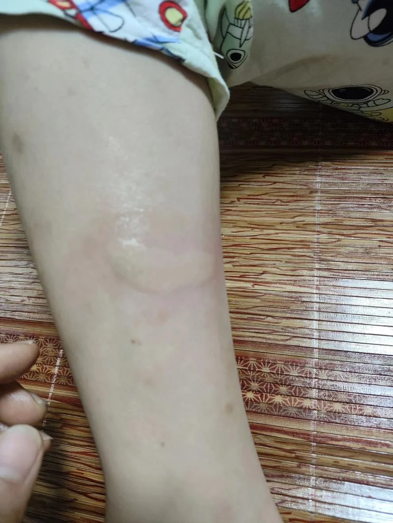 梦到好多蚊子咬我_1