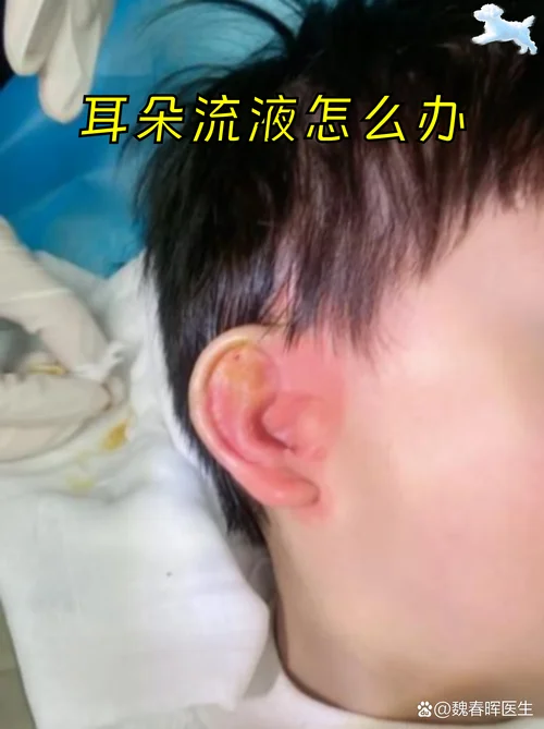 梦见耳朵流脓_2
