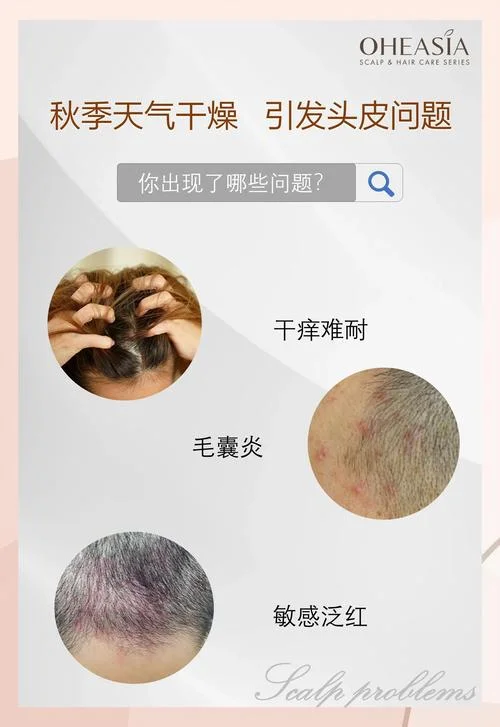 头皮痒头屑多掉头发怎么办-头皮痒掉发咋办