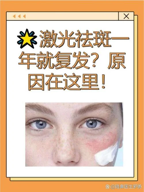 激光去斑多少钱1次_1