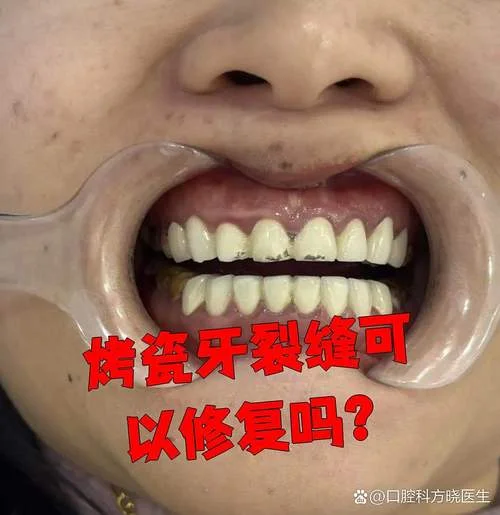 梦到烤瓷牙掉了_1