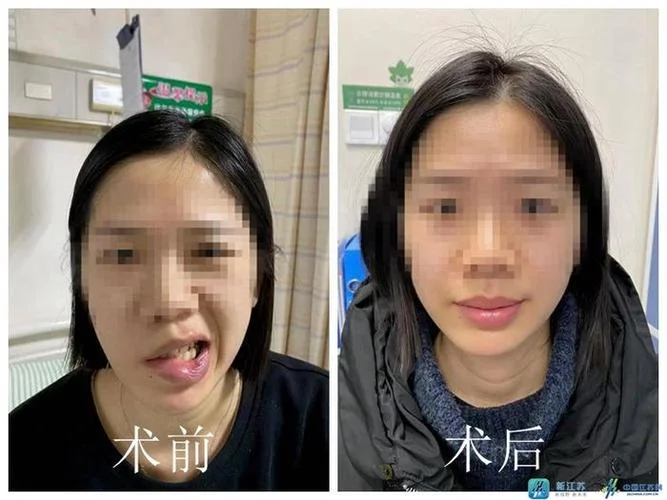 面瘫手术需要多少钱_1