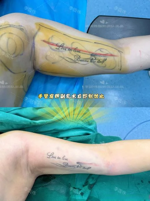 上臂抽脂大约多少钱_2
