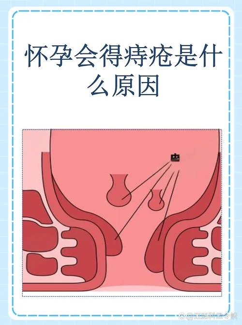 孕妇长痔疮怎么办呢_1