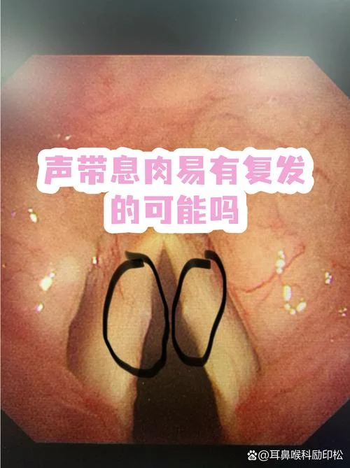 声带息肉切除多少钱_2
