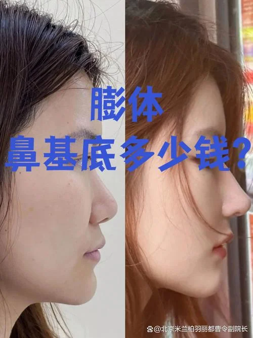 膨体隆鼻多少钱隆鼻_1