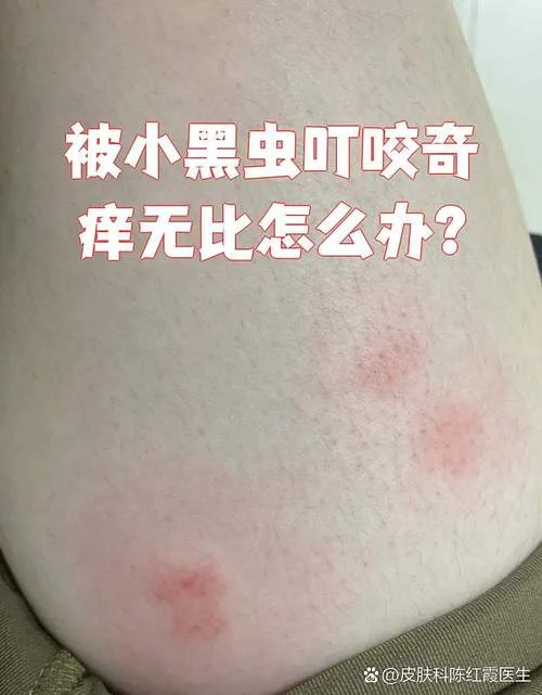 做梦梦到被虫子咬了_1