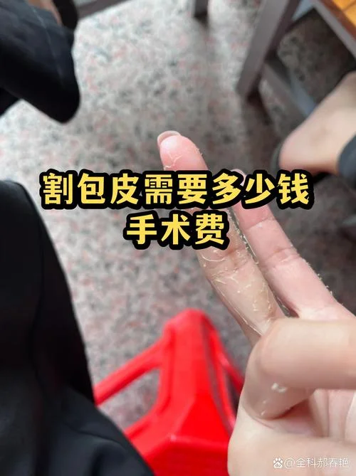 包茎手术得多少钱啊_1