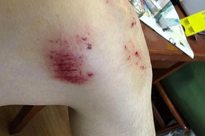 梦见蛇咬自己的腿出血_1