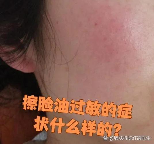 脸爱过敏是缺什么_2