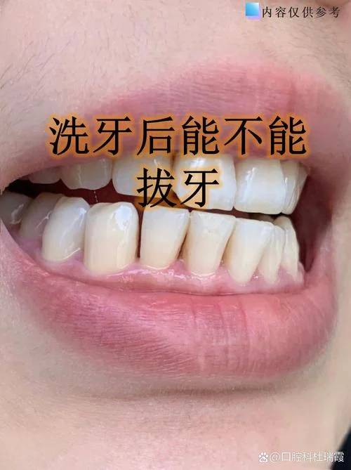 梦见洗牙垢_1