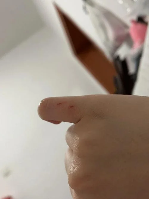 做梦梦到狗咬手流血了_1