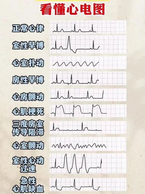 介绍一下心脏早搏_1