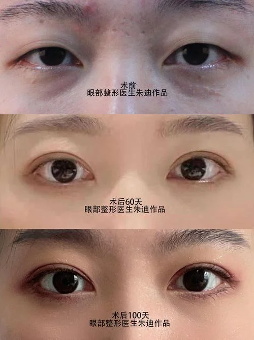 杭州双眼皮多少钱_2