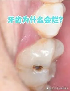 女人梦见牙齿腐烂_2