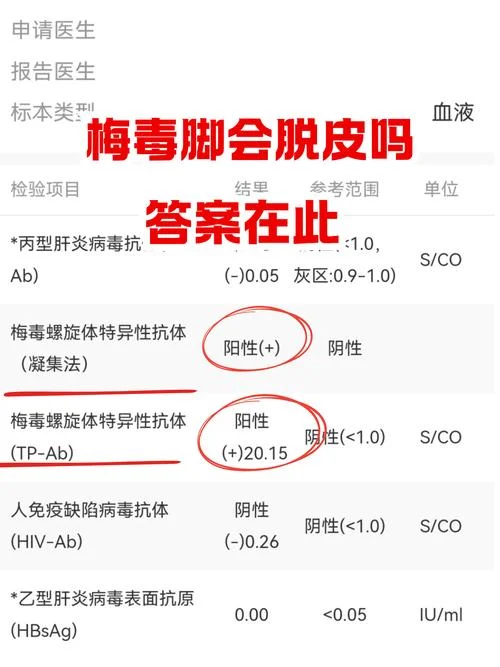 梅毒血清反应素阴性是什么意思-梅毒反应素阴性