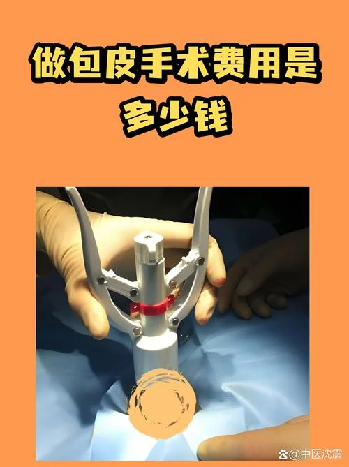 韩式包皮手术需要多少钱_2
