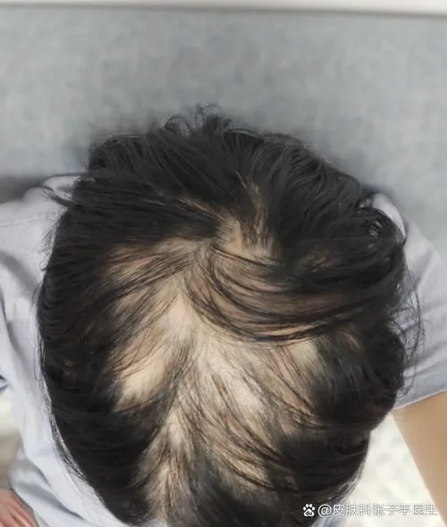 年轻人满头掉头发是缺什么_1