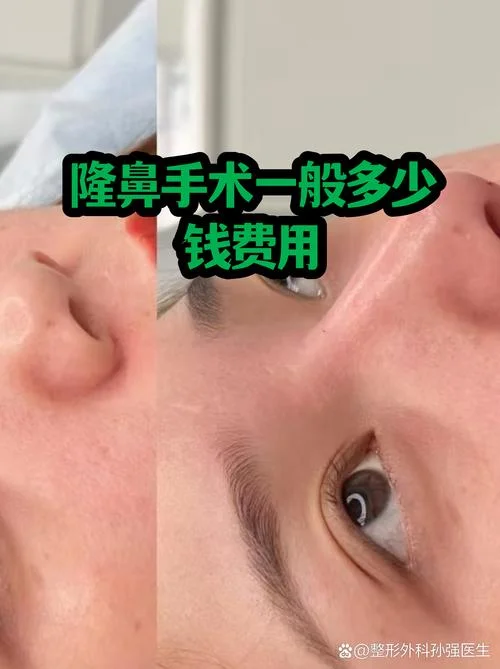 隆鼻的手术多少钱_2